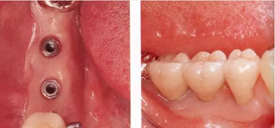 種植體周圍角化齦的獲得時期與方法 種植體周圍角化齦的獲得時期與方法