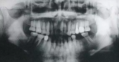 種植體周圍角化齦的獲得時期與方法 種植體周圍角化齦的獲得時期與方法