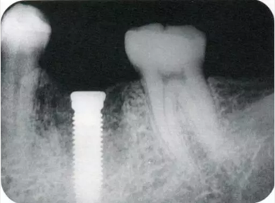 種植體周圍角化齦的獲得時期與方法 種植體周圍角化齦的獲得時期與方法