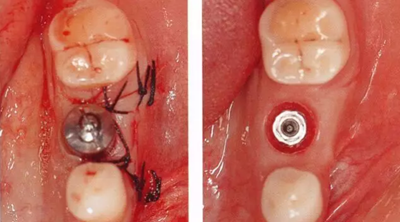 種植體周圍角化齦的獲得時期與方法 種植體周圍角化齦的獲得時期與方法