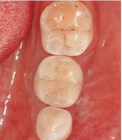 種植體周圍角化齦的獲得時期與方法 種植體周圍角化齦的獲得時期與方法