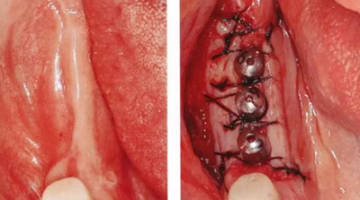 種植體周圍角化齦的獲得時期與方法 種植體周圍角化齦的獲得時期與方法