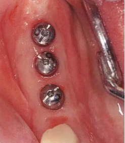 種植體周圍角化齦的獲得時期與方法 種植體周圍角化齦的獲得時期與方法