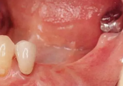 種植體周圍角化齦的獲得時期與方法 種植體周圍角化齦的獲得時期與方法