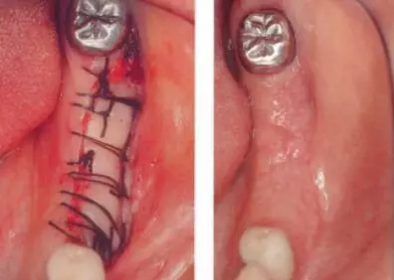 種植體周圍角化齦的獲得時期與方法 種植體周圍角化齦的獲得時期與方法