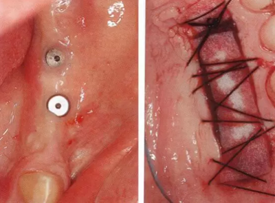 種植體周圍角化齦的獲得時期與方法 種植體周圍角化齦的獲得時期與方法
