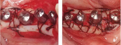 種植體周圍角化齦的獲得時期與方法 種植體周圍角化齦的獲得時期與方法