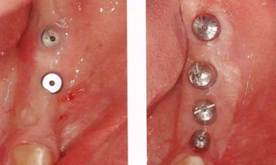 種植體周圍角化齦的獲得時期與方法 種植體周圍角化齦的獲得時期與方法