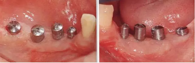 種植體周圍角化齦的獲得時期與方法 種植體周圍角化齦的獲得時期與方法