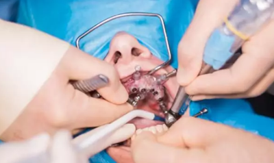 種植體與神經(jīng)管的「相愛相殺」 種植體與神經(jīng)管的「相愛相殺」