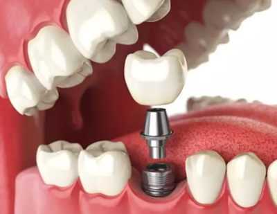 種植體與神經(jīng)管的「相愛相殺」 種植體與神經(jīng)管的「相愛相殺」