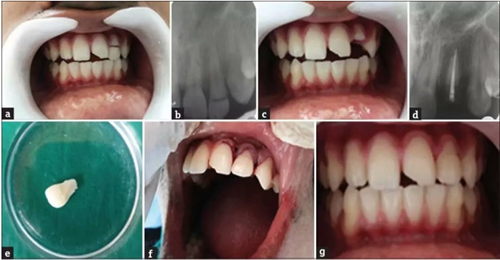  [牙體牙髓] 【病例報(bào)告】纖維樁及牙折片重粘接修復(fù)折斷牙  