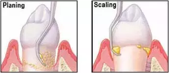 為什么洗牙后還要做牙周刮治？