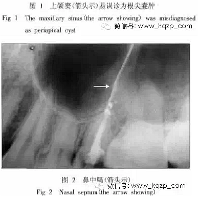 X線牙片在牙齒疑難病例診斷中的參考價值 X線牙片在牙齒疑難病例診斷中的參考價值