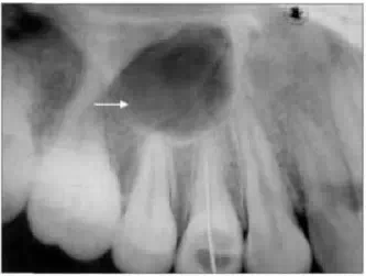 X線牙片在牙齒疑難病例診斷中的參考價值 X線牙片在牙齒疑難病例診斷中的參考價值