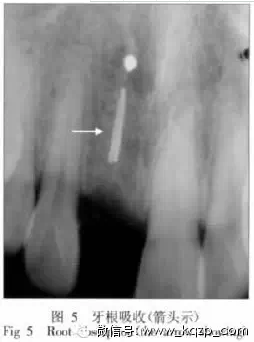 X線牙片在牙齒疑難病例診斷中的參考價值 X線牙片在牙齒疑難病例診斷中的參考價值