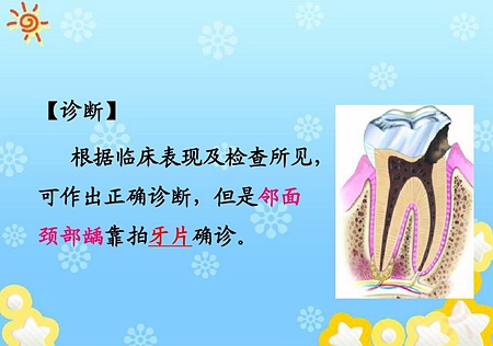 齲病診斷和鑒別診斷 齲病診斷和鑒別診斷