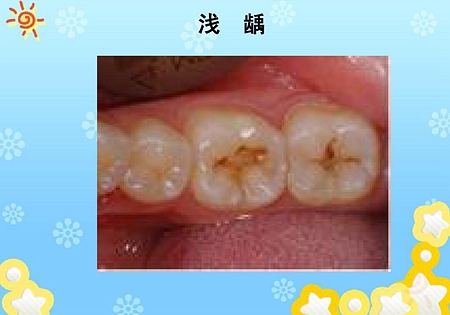 齲病診斷和鑒別診斷 齲病診斷和鑒別診斷