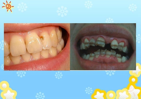 齲病診斷和鑒別診斷 齲病診斷和鑒別診斷