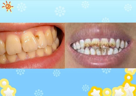 齲病診斷和鑒別診斷 齲病診斷和鑒別診斷