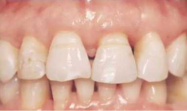 鄰面去釉技術(shù)詳解 鄰面去釉技術(shù)詳解