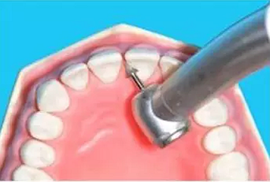 鄰面去釉技術(shù)詳解 鄰面去釉技術(shù)詳解