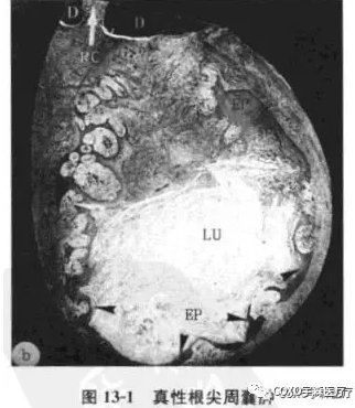 根尖周病的鑒別診斷 根尖周病的鑒別診斷