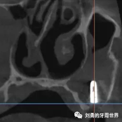 失敗上頜竇種植患者的補(bǔ)救 失敗上頜竇種植患者的補(bǔ)救