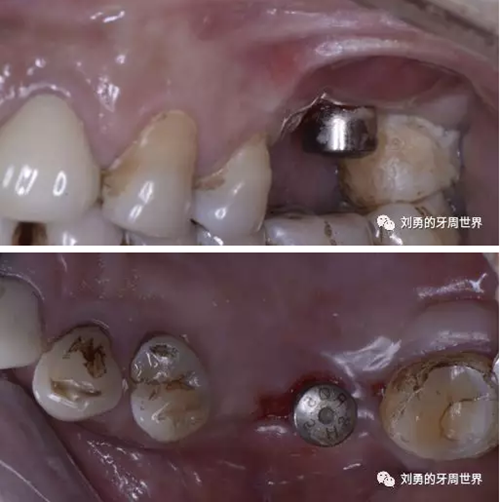 一例失敗上頜竇種植患者的補(bǔ)救 一例失敗上頜竇種植患者的補(bǔ)救