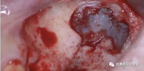 一例失敗上頜竇種植患者的補(bǔ)救 一例失敗上頜竇種植患者的補(bǔ)救