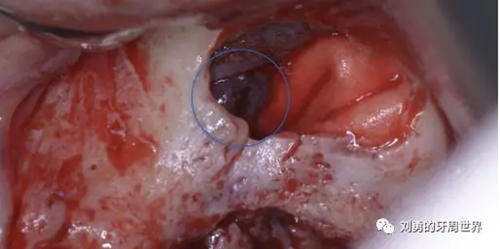 一例失敗上頜竇種植患者的補(bǔ)救 一例失敗上頜竇種植患者的補(bǔ)救