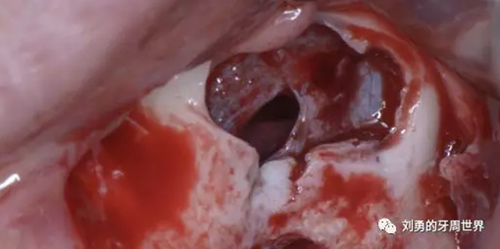 一例失敗上頜竇種植患者的補(bǔ)救 一例失敗上頜竇種植患者的補(bǔ)救