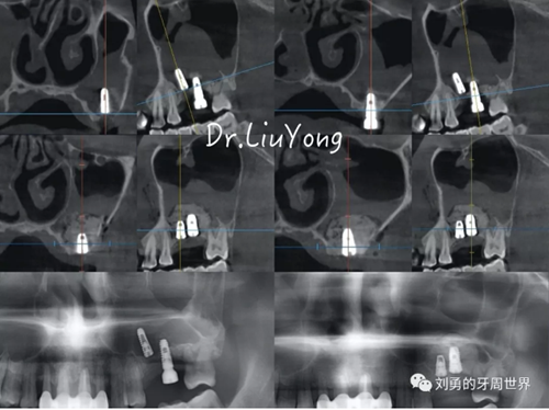 一例失敗上頜竇種植患者的補(bǔ)救 一例失敗上頜竇種植患者的補(bǔ)救