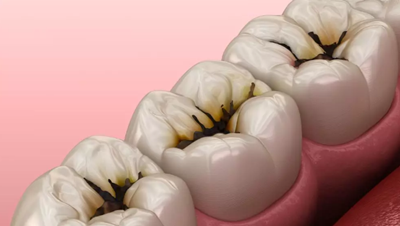 讓牙隱裂的診治少點(diǎn)「糾結(jié)」 讓牙隱裂的診治少點(diǎn)「糾結(jié)」