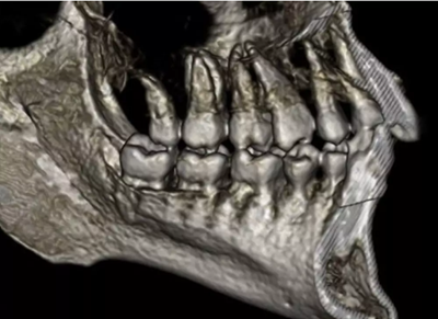 正畸文獻(xiàn)賞析--CBCT在正畸中的廣泛應(yīng)用 正畸文獻(xiàn)賞析--CBCT在正畸中的廣泛應(yīng)用