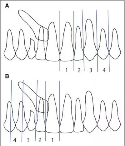 正畸文獻(xiàn)賞析--埋伏/阻生尖牙的正畸治療 正畸文獻(xiàn)賞析--埋伏/阻生尖牙的正畸治療
