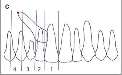 正畸文獻(xiàn)賞析--埋伏/阻生尖牙的正畸治療 正畸文獻(xiàn)賞析--埋伏/阻生尖牙的正畸治療