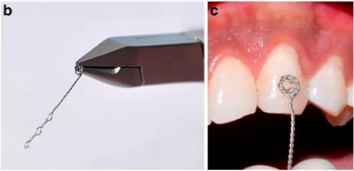 正畸文獻(xiàn)賞析--埋伏/阻生尖牙的正畸治療 正畸文獻(xiàn)賞析--埋伏/阻生尖牙的正畸治療