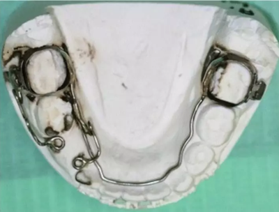 正畸文獻(xiàn)賞析--埋伏/阻生尖牙的正畸治療 正畸文獻(xiàn)賞析--埋伏/阻生尖牙的正畸治療