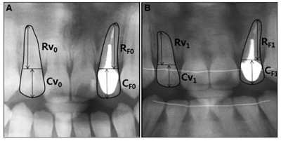 正畸文獻(xiàn)閱讀--正畸與口內(nèi)治療的關(guān)系 正畸文獻(xiàn)閱讀--正畸與口內(nèi)治療的關(guān)系