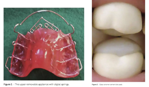 正畸文獻閱讀--青少年不同矯治方案的影響 正畸文獻閱讀--青少年不同矯治方案的影響