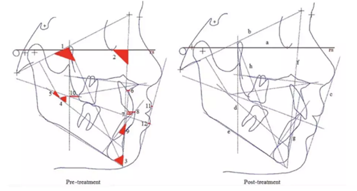 正畸文獻閱讀--青少年不同矯治方案的影響 正畸文獻閱讀--青少年不同矯治方案的影響