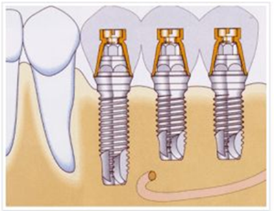戰(zhàn)&ldquo;疫&rdquo;護(hù)牙方法：&ldquo;坐困家中&rdquo;，誰來救救我的種植牙？