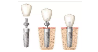 戰(zhàn)&ldquo;疫&rdquo;護(hù)牙方法：&ldquo;坐困家中&rdquo;，誰來救救我的種植牙？
