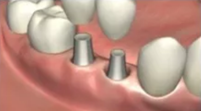 疫情期間，種植科突發(fā)狀況居家處理建議
