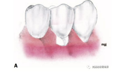 FGG游離牙齦移植在歷史上的各種改良以及發(fā)展前景 FGG游離牙齦移植在歷史上的各種改良以及發(fā)展前景