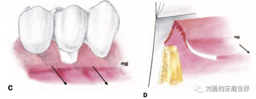 FGG游離牙齦移植在歷史上的各種改良以及發(fā)展前景 FGG游離牙齦移植在歷史上的各種改良以及發(fā)展前景