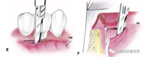 FGG游離牙齦移植在歷史上的各種改良以及發(fā)展前景 FGG游離牙齦移植在歷史上的各種改良以及發(fā)展前景