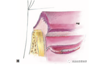 FGG游離牙齦移植在歷史上的各種改良以及發(fā)展前景 FGG游離牙齦移植在歷史上的各種改良以及發(fā)展前景
