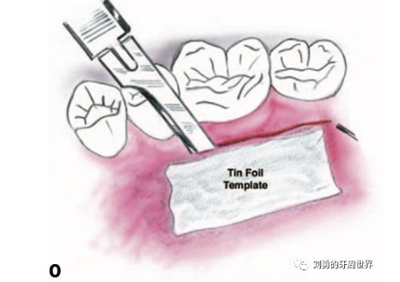 FGG游離牙齦移植在歷史上的各種改良以及發(fā)展前景 FGG游離牙齦移植在歷史上的各種改良以及發(fā)展前景